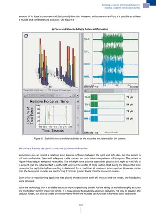Refining occlusion with muscle balance to
                                                                                      enhance long-term orthodontic stability


amount of its force in a non-vertical (horizontal) direction. However, with some extra effort, it is possible to achieve
a muscle and force balanced occlusion. See Figure 8.



                                 A Force and Muscle Activity Balanced Occlusion




              Figure 8. Both the forces and the activities of the muscles are balanced in this patient.



Balanced Forces do not Guarantee Balanced Muscles

Sometimes we can record a relatively even balance of forces between the right and left sides, but the patient is
still not comfortable. Even with adequate stable contacts on both sides some patients still complain. The patient in
Figure 9 had regular temporal headaches. The left-right force balance was rather good at 56% right to 44% left. It
is evident that the initial contact is on the left side (see the center of force vector), that during the closure the force
passes to the right side before reaching its balanced force condition at maximum intercuspation. However, notice
that the temporalis muscles are contracting 2 ½ times greater levels than the masseter muscles.

Soon after a repositioning appliance was placed that balanced both the muscle and the forces, the headaches
were relieved.

With the technology that is available today an ordinary practicing dentist has the ability to more thoroughly evaluate
the masticatory system than ever before. It is now possible to routinely adjust an occlusion, not only to equalize the
occlusal forces, but also to create an environment where the muscles can function in harmony with each other.



                                                            181
 