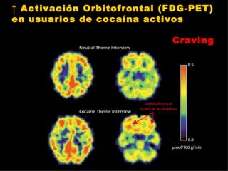 ↑  Activación Orbitofrontal (FDG-PET) en usuarios de cocaína activos Craving 