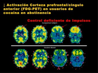 ↓  Activación Corteza prefrontal/cingulo anterior (FDG-PET) en usuarios de cocaína en abstinencia Control deficiente de Impulsos 