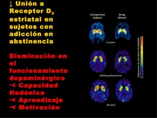 ↓  Unión a Receptor D 2  estriatal en sujetos con adicción en abstinencia Disminución en el funcionamiento dopaminérgico < Capacidad Hedónica < Aprendizaje < Motivación 