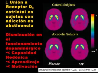↓  Unión a Receptor D 2  estriatal en sujetos con adicción en abstinencia Disminución en el funcionamiento dopaminérgico < Capacidad Hedónica < Aprendizaje < Motivación 