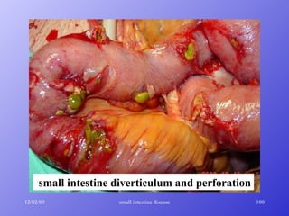small intestine diverticulum and perforation 
