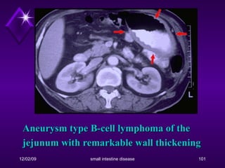 Aneurysm type B-cell lymphoma of the jejunum with remarkable wall thickening   