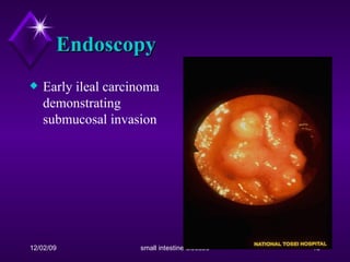Endoscopy Early ileal carcinoma demonstrating submucosal invasion  