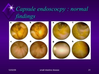 Capsule endoscocpy : normal findings 