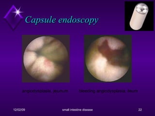 Capsule endoscopy angiodysplasia, jejunum   bleeding angiodysplasia, ileum   