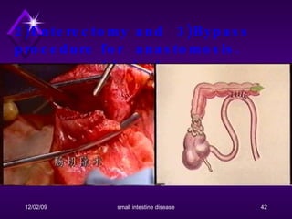 2)Enterectomy and  3)Bypass procedure for  anastomosis.  nonresectable lesions. 