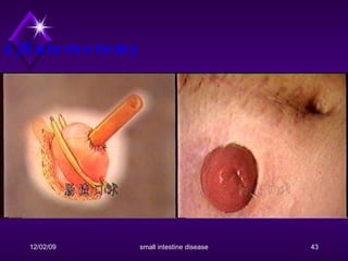 4)Enterostomy 