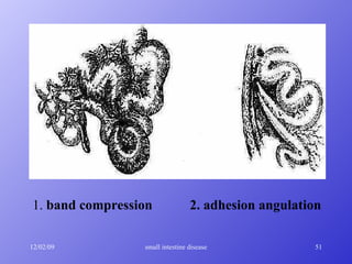 1.  band compression  2. adhesion angulation 