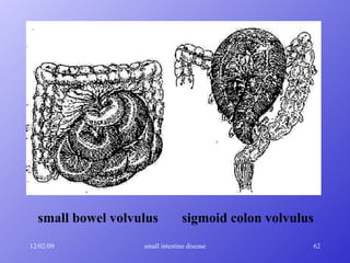 small bowel volvulus  sigmoid colon volvulus   