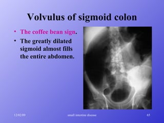 Volvulus of sigmoid colon The coffee bean sign .  The greatly dilated sigmoid almost fills the entire abdomen.   