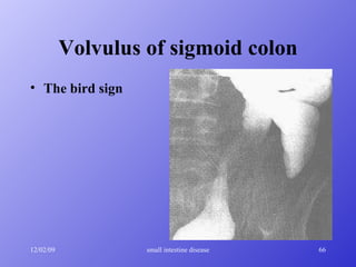 Volvulus of sigmoid colon The bird sign 