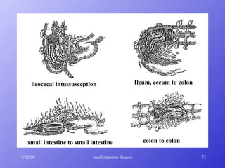 small intestine to small intestine ileocecal intussusception Ileum, cecum to colon colon to colon 