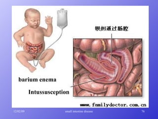 barium enema Intussusception 