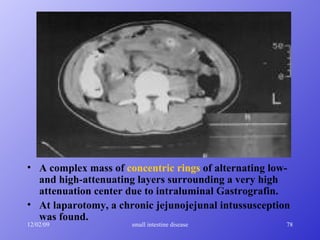 A complex mass of  concentric rings  of alternating low- and high-attenuating layers surrounding a very high attenuation center due to intraluminal Gastrografin. At laparotomy, a chronic jejunojejunal intussusception was found.   