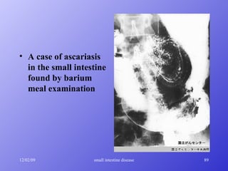 A case of ascariasis in the small intestine found by barium meal examination   