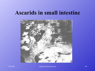 Ascarids in small intestine 
