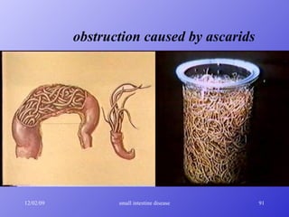 obstruction caused by ascarids 