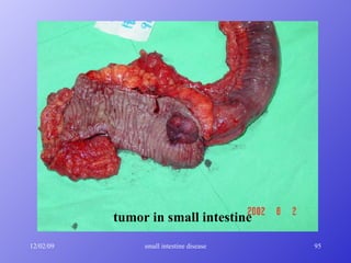 tumor in small intestine 
