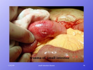 trauma of  small intestine 