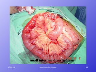 small intestine diverticulum 