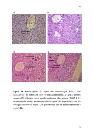 79
A B
Espaço porta
Cordões de
hepatócitos
C D
Necrose focal
Esteatose em
microgotas
Pigmentos de hemossiderina
Esteatose em
microgotas
Necrose
Figura 24: Fotomicrografia do fígado dos camundongos após 7 dias
consecutivos de tratamento com 15-deoxigoiazensolido. O grupo controle
negativo (A) foi tratado com o veiculo usado para diluir a droga (DMSO 2 %).
Grupo controle positivo tratado com 5-FU 50 mg/m2
(B), grupo tratado com 15-
deoxigoiazensolido 10 mg/m2
(C) e grupo tratado com 15-deoxigoiazensolido 5
mg/m2
(D).
79
 
