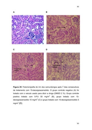 80
A B
NTA
C D
Tumefação
celular
NTA
NTA
Tumefação
celular
Figura 25: Fotomicrigrafia do rim dos camundongos após 7 dias consecutivos
de tratamento com 15-deoxigoiazensolido. O grupo controle negativo (A) foi
tratado com o veiculo usado para diluir a droga (DMSO 2 %). Grupo controle
positivo tratado com 5-FU 50 mg/m2
(B), grupo tratado com 15-
deoxigoiazensolido 10 mg/m2
(C) e grupo tratado com 15-deoxigoiazensolido 5
mg/m2
(D).
80
 