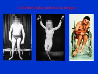 Cerebral palsy and ataxia images 