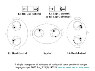 A single therapy for all subtypes of horizontal canal positional vertigo. Laryngoscope. 2005 Aug;115(8):1432-5  Chiou  WY ,  Lee HL ,  Tsai SC ,  Yu TH ,  Lee XX . 