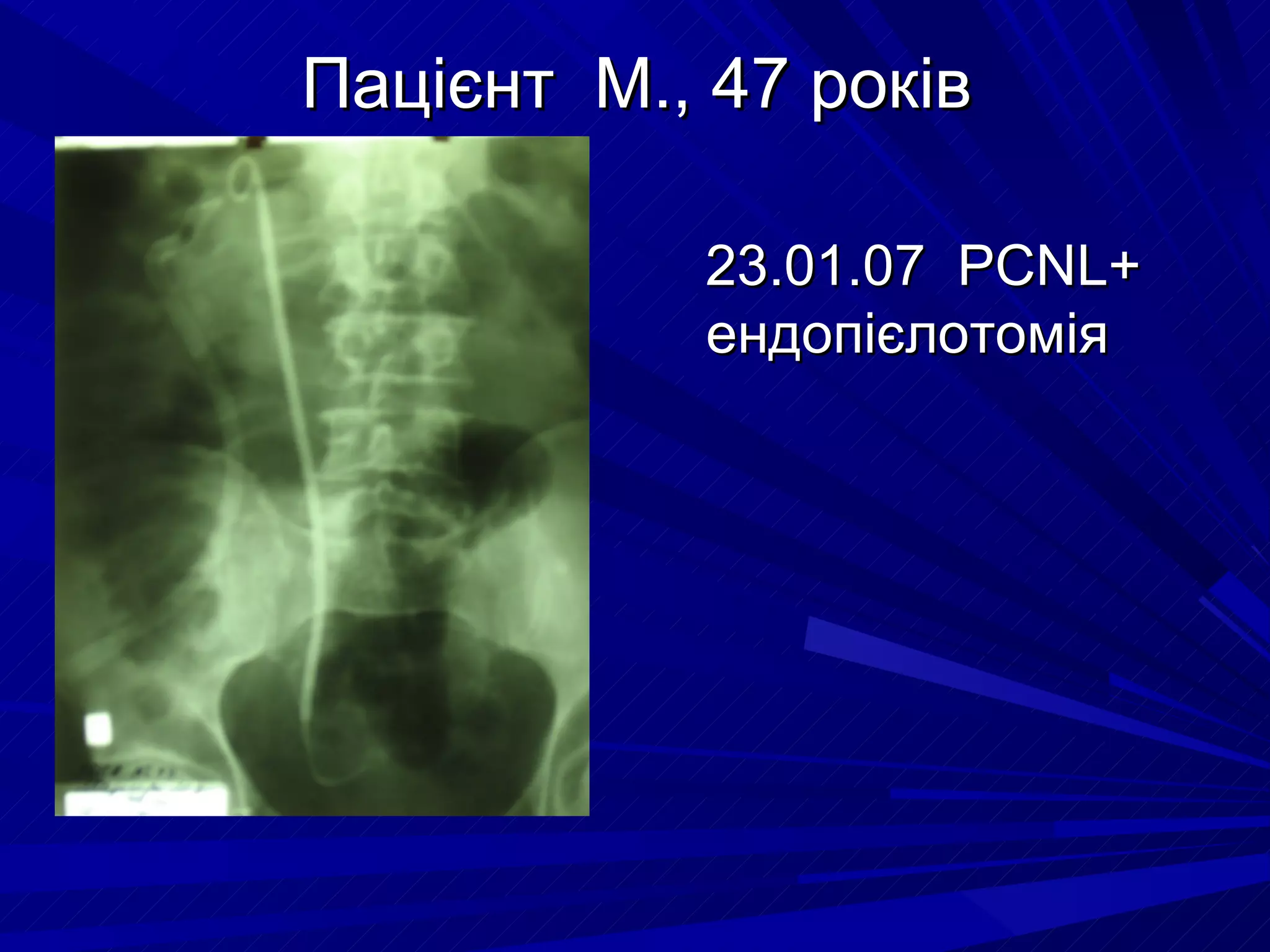 Пацієнт  М. ,  47 років 23.01.07  PCNL+  ендопієлотомія 