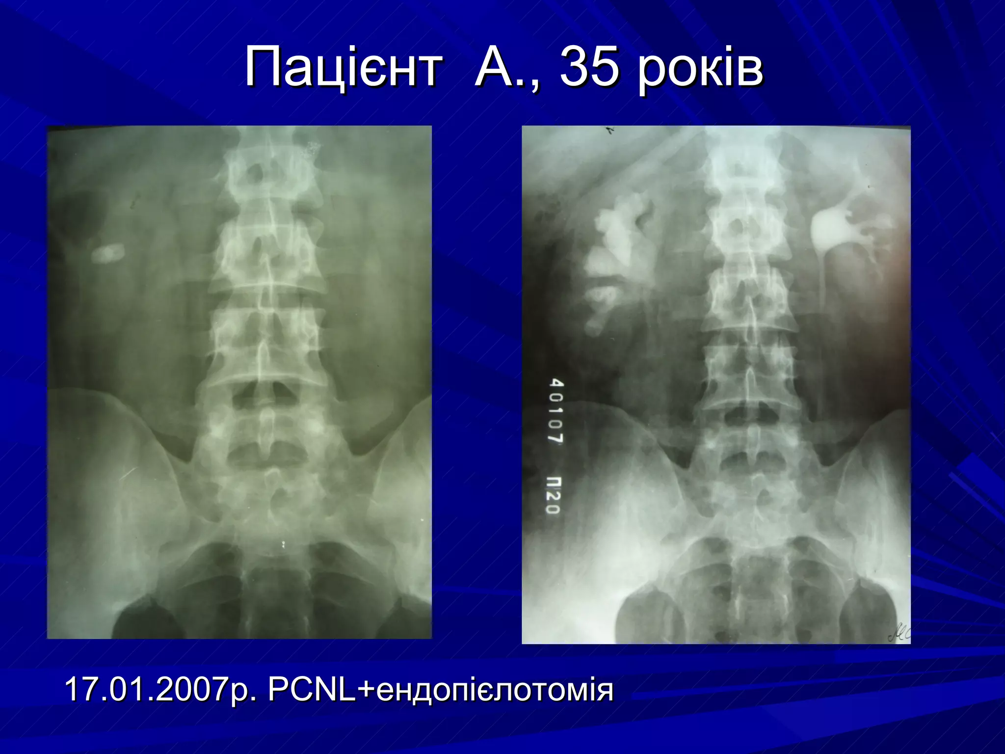 Пацієнт  А. ,  35 років 17.01.2007р.  PCNL+ ендопієлотомія  