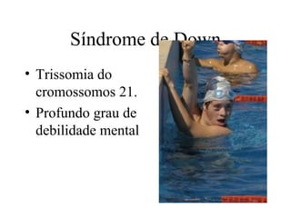 Síndrome de Down
• Trissomia do
  cromossomos 21.
• Profundo grau de
  debilidade mental
 