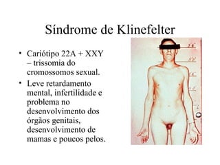 Síndrome de Klinefelter
• Cariótipo 22A + XXY
  – trissomia do
  cromossomos sexual.
• Leve retardamento
  mental, infertilidade e
  problema no
  desenvolvimento dos
  órgãos genitais,
  desenvolvimento de
  mamas e poucos pelos.
 