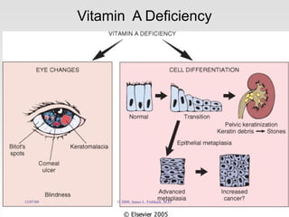 Vitamin  A Deficiency 06/07/09 © 2009, James L. Fishback, M.D. 