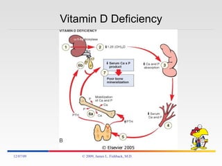 Vitamin D Deficiency 06/07/09 © 2009, James L. Fishback, M.D. 