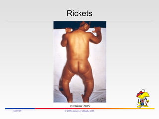 Rickets 06/07/09 © 2009, James L. Fishback, M.D. 