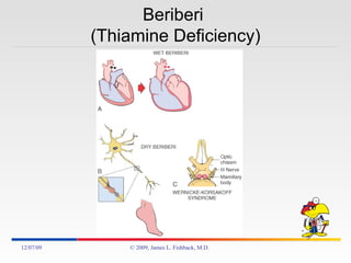 Beriberi  (Thiamine Deficiency) 06/07/09 © 2009, James L. Fishback, M.D. 