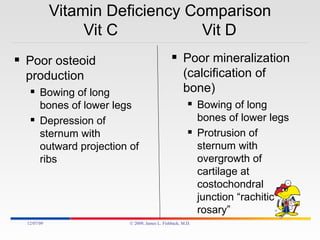 Vitamin Deficiency Comparison Vit C  Vit D Poor osteoid production Bowing of long bones of lower legs Depression of sternum with outward projection of ribs  Poor mineralization (calcification of bone) Bowing of long bones of lower legs Protrusion of sternum with overgrowth of cartilage at costochondral junction “rachitic rosary” 06/07/09 © 2009, James L. Fishback, M.D. 