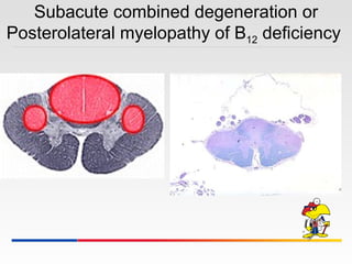Subacute combined degeneration or Posterolateral myelopathy of B 12  deficiency  