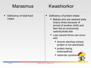 Marasmus  Kwashiorkor Deficiency of total food intake Deficiency of protein intake  Babies who are weaned early (many times because of arrival of another child) and then fed an exclusively carbohydrate diet Less severe forms can occur with  chronic diarrhea (where protein is not absorbed) protein losing enteropathies nephrotic syndrome 06/07/09 © 2009, James L. Fishback, M.D. 