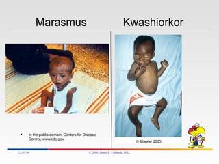 Marasmus  Kwashiorkor In the public domain, Centers for Disease Control, www.cdc.gov 06/07/09 © 2009, James L. Fishback, M.D. 