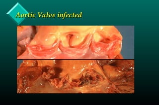 Aortic Valve infectedAortic Valve infected
 