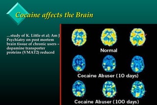 Cocaine affects the BrainCocaine affects the Brain
……study of K. Little et al; Am Jstudy of K. Little et al; Am J
Psychiatry on post mortemPsychiatry on post mortem
brain tissue of chronic users –brain tissue of chronic users –
dopamine transporterdopamine transporter
proteins (VMAT2) reducedproteins (VMAT2) reduced
 