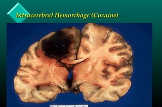Intracerebral Hemorrhage (Cocaine)Intracerebral Hemorrhage (Cocaine)
 