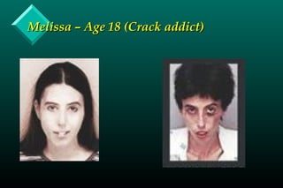 Melissa – Age 18 (Crack addict)Melissa – Age 18 (Crack addict)
 
