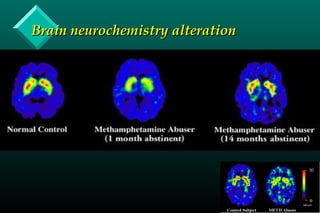 Brain neurochemistry alterationBrain neurochemistry alteration
 