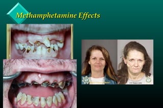 Methamphetamine EffectsMethamphetamine Effects
 