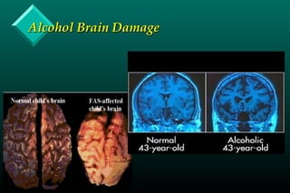 Alcohol Brain DamageAlcohol Brain Damage
 
