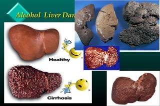 Alcohol Liver DamageAlcohol Liver Damage
 