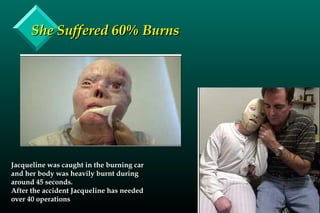 She Suffered 60% BurnsShe Suffered 60% Burns
Jacqueline was caught in the burning car
and her body was heavily burnt during
around 45 seconds.
After the accident Jacqueline has needed
over 40 operations
 